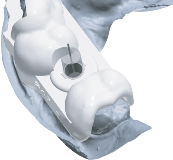Digital Implant Guide Surgical Guide by Minimax Implant